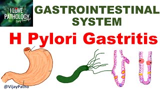 H Pylori Gastritis  Epidemiology Pathogenesis Clinical features Sequelae amp Treatment [upl. by Halima]