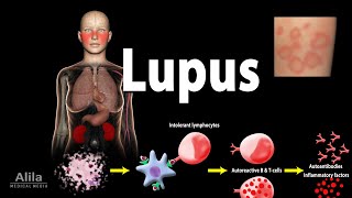 Lupus Symptoms Risk factors Pathophysiology Diagnosis and Treatments [upl. by Kampmann476]