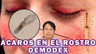 COMO ELIMINAR AL DEMODEX [upl. by Pammie]