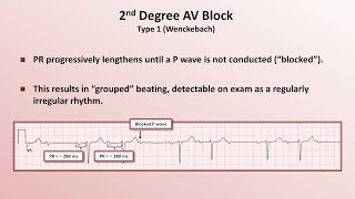 Intro to EKG Interpretation  AV Block [upl. by Armond]