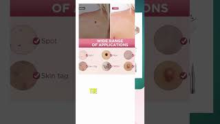 Best Skin Tag Removal Kit Reviews  Best Reviews Blog 2023 [upl. by Alyahs]