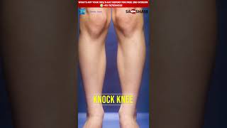 Understanding the Causes of Knock Knees Insights from Dr Debashish ChandaDrdebashishChanda [upl. by Panthia542]