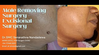 Mole Removing Surgery  Excisional Surgery [upl. by Philan703]