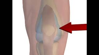 Arthrocentesis of the Knee NEJM [upl. by Julienne]