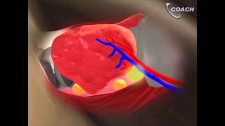 Minimally Invasive Total Thyroidectomy Video [upl. by Pietro]