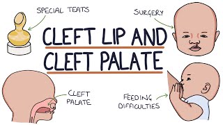 Cleft Lip and Cleft Palate For Students [upl. by Onifur]