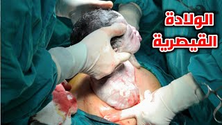 شاهد كيف تكون الولادة القيصريةCaesarean section [upl. by Zahc]