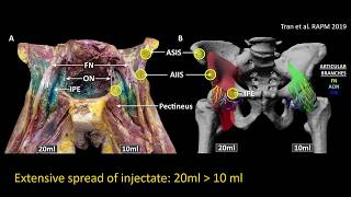 Pericapsular Nerve Group PENG block for hip analgesia [upl. by Crichton507]