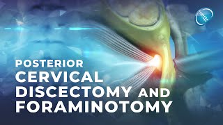 What is Endoscopic Posterior Cervical Discectomy and Foraminotomy [upl. by Hagep]