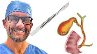 Treating Acute Cholecystitis with a Surgeon [upl. by Estele]