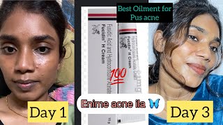 Best Oilment for pus acne  pimples [upl. by Allac15]