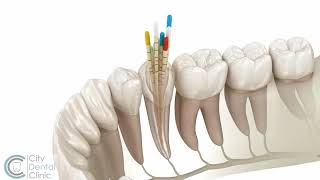 Endodontie  Wurzelbehandlung  City Dental Clinic Bratislava [upl. by Berriman402]