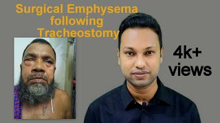 Surgical Emphysema following Tracheostomy [upl. by Rainer]