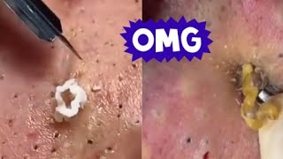 Top Acne Scar Treatments Proven Methods to Clear Your Skin Fast [upl. by Coveney532]