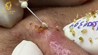 Treatment of blackheads and whiteheads 394  Loan Nguyen [upl. by Adnuhsal]