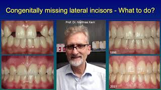 Congenitally missing lateral incisors  What to do [upl. by Adne]