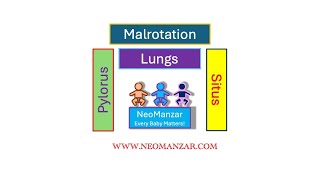 Malrotation Pyloric atresia Situs Inversus [upl. by Reis471]