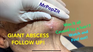 Giant chin abscess follow up Was it all caused by a HAIR See the interesting dissection here [upl. by Peggi]