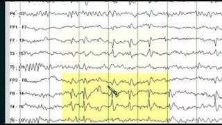 Focal EEG Abnormalities 1 [upl. by Aisilef677]