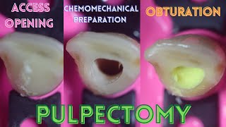 Access Opening ⚪️ Chemomechanical Preparation 🟢 Obturation 🟡 Pulpectomy 🟠 Primary Central Incisor [upl. by Eenafets]