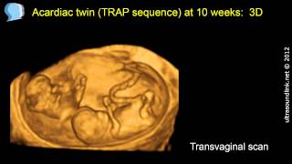 Acardiac twin TRAP sequence at 10 weeks [upl. by Doscher]