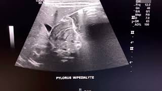 Ultrasound cases POSITIVE Hypertrophic Pyloric Stenosis  pediatric sonography [upl. by Somar252]