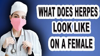 What Does Herpes Look Like On A Female [upl. by Birdella734]