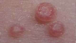 How to treat Molluscum Contagiosum [upl. by Neelsaj]