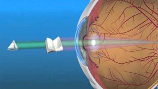 Multifocal Lens IOL [upl. by Eejan]