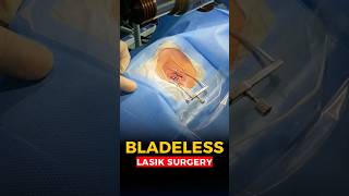 Bladeless LASIK Procedure [upl. by Nanah7]