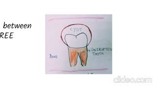 Dentigerous Cyst  Pathogenesis [upl. by Anivahs396]