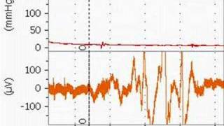 Bupivacaine Cardiotoxicity in an Anesthetized Rat [upl. by Richy]