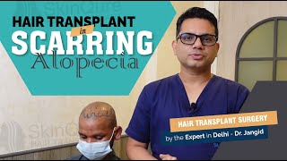 Hair Transplant in Scaring Alopecia  Best Hair Transplant Clinic in Delhi [upl. by Cony]