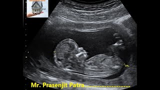 How To Do Fetal Biometry [upl. by Desmond743]