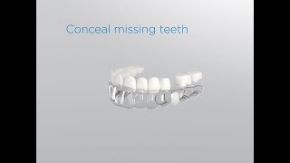 SureSmile Aligners Pontics [upl. by Leachim]