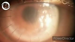 Corneal graft rejection [upl. by Eidorb675]