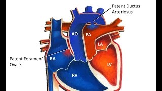 Transposition of the Great Arteries Echocardiography [upl. by Mosby]