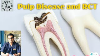 Pulp Disease and Root canal Treatment RCT [upl. by Huskey]