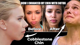 Botox to the Chin Before and Afters  What is Cobblestone chin [upl. by Norean]