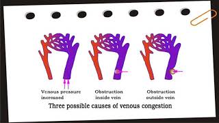 Hyperemia and Congestion [upl. by Hserus]