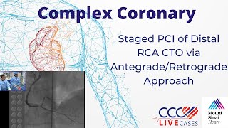 Staged PCI of Distal RCA CTO via AntegradeRetrograde Approach  September 16 2014 Webcast [upl. by Aryahay]