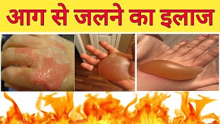 आग से जलने पर बेस्ट ईलाजजली हुई स्किन की दवाइयाँ Skin burn treatmentBest Treatment Burn care [upl. by Forsta74]