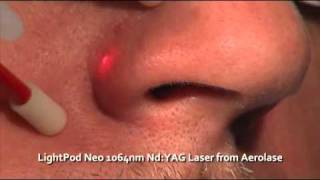 Facial Vessel Removal  The LightPod Neo 1064nm Laser by Aerolase [upl. by Onyx322]