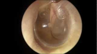 Serous Otitis Media [upl. by Leshia]