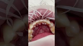 Placing a fixed retainer after Invisalign 🫶 [upl. by Doone769]