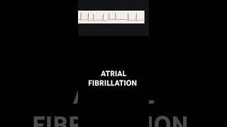 how to identify Atrial fibrillation in an ECGEKG [upl. by Chickie]