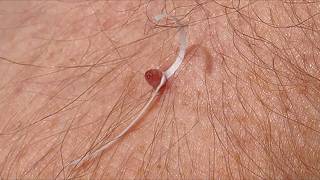 TOP 8 SKIN TAG REMOVAL Removal Methods Commonly Used at HOME [upl. by Nnylear232]