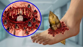 ASMR Treat severe leg wounds amp Remove parasitic leeches  Deep Cleaning Animation [upl. by Llimaj]