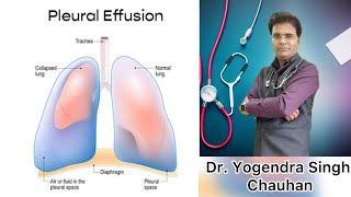 Pleural effusion  pleuracy  फेंफड़ों में पानी भर जाना [upl. by Ase544]