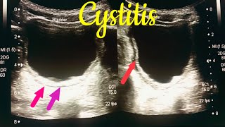 Cystitis kya hota hai  cystitis in children  cystitis symptoms  cystitis ultrasound [upl. by Eornom]